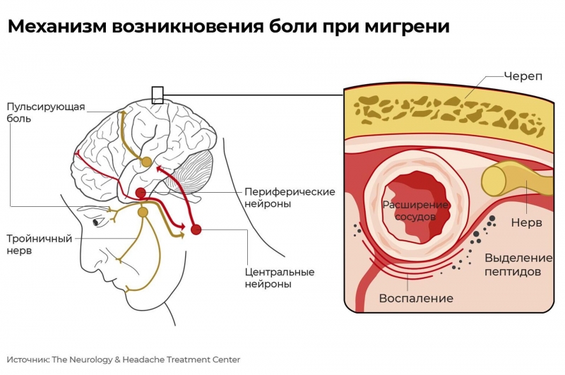 Больные на голову. Ученые нашли возможную причину мигрени