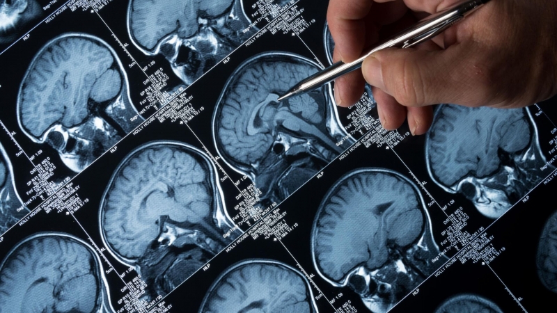Российские ученые предложили новый подход к борьбе с болезнью Альцгеймера