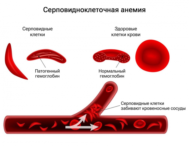 Исправление мутаций. Предложена новая терапия опасных болезней крови