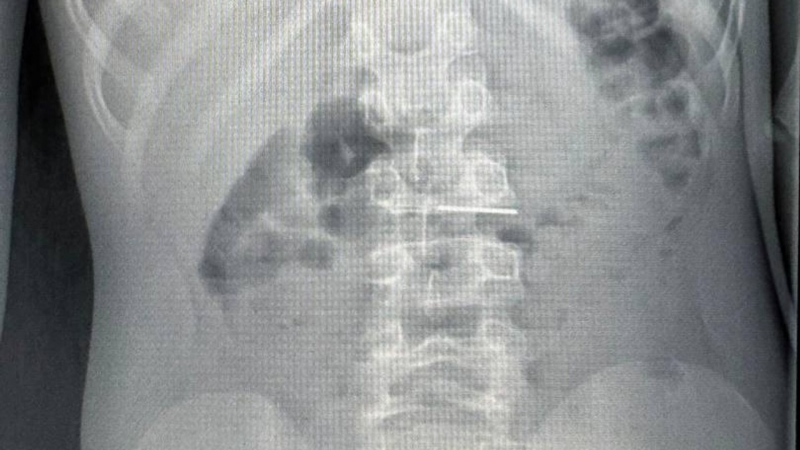 В Иркутске новорожденному провели операцию с помощью ангиографа