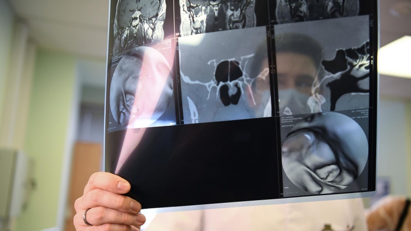 В России разработали веб-приложение для выявления опухолей головного мозга